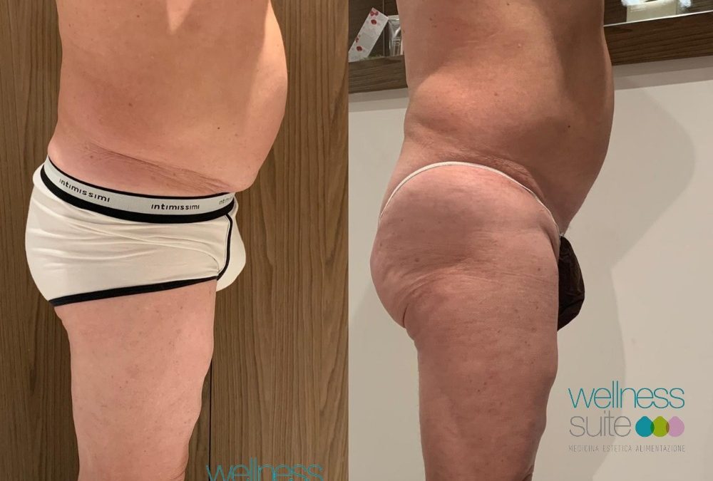 RISULTATO STRAORDINARIO IN SOLE 5 SEDUTE!
 Liposcultura Antiage – Prima & Dopo
…