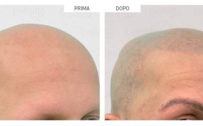 TRICOPIGMENTAZIONE: LA SOLUZIONE ALLA CALVIZIA 
 Perdere i capelli è un vero dra…