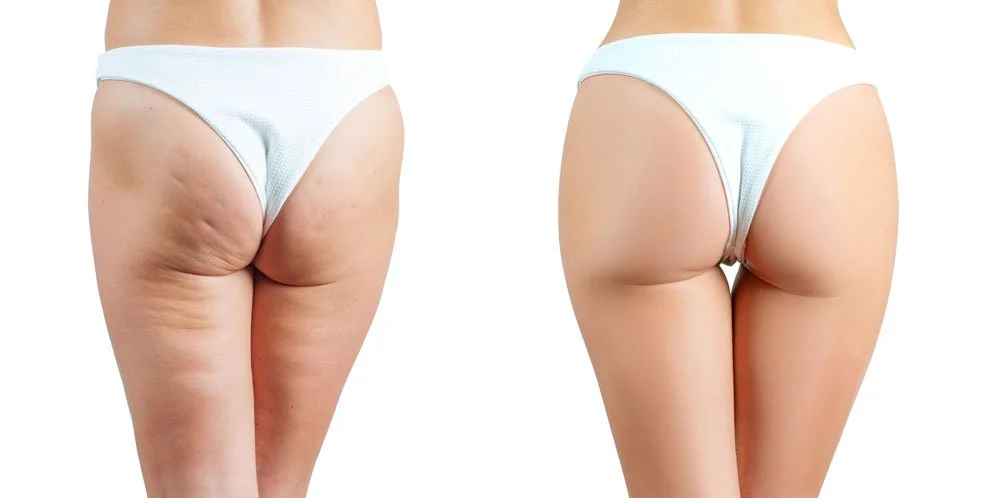 corpo perfetto cellulite wellnesssuite home corpo perfetto cellulite wellnesssuite home