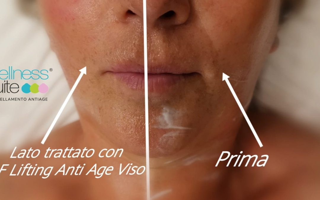E sorprendente come un solo trattamento Lifting Anti Age Viso