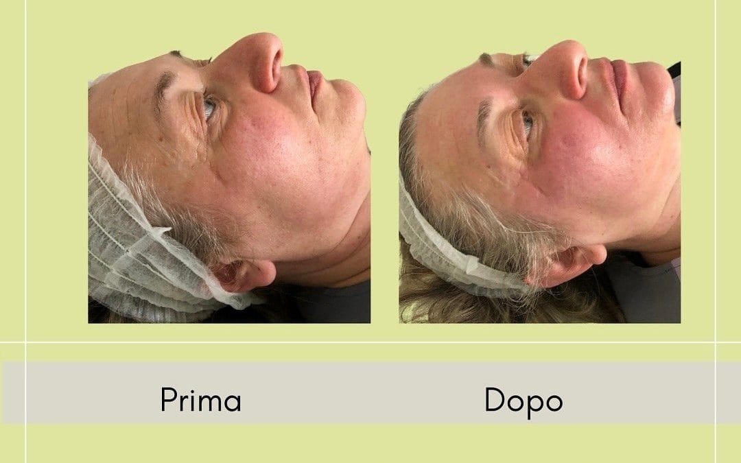 Trattamento agli esosomi ~ effetto botox senza punture   
Gli esosomi trasmetto…