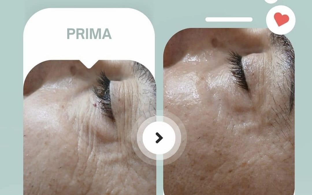 NOVITA’ ESCLUSIVA WELLNESS SUITE!!!
ILLUMINEYE…
Un trattamento di mesoterapia …