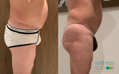 RISULTATO STRAORDINARIO IN SOLE 5 SEDUTE!
 Liposcultura Antiage – Prima & Dopo
…