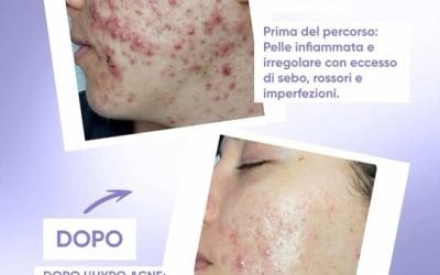 Il Mesopeeling all’ossigeno a tre strati è la nuova direzione innovativa della …