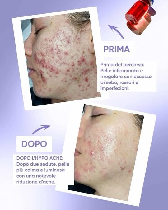 Il Mesopeeling all’ossigeno a tre strati è la nuova direzione innovativa della …