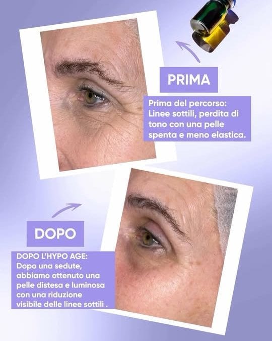 Oxygen Mesopeeling HYPO AGE – ringiovanente con effetto Botox-like immediato 
H…