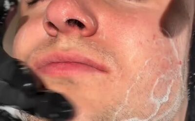 Il Mesopeeling all’ossigeno a tre strati è la nuova direzione innovativa della c…