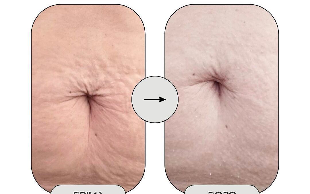 Risultati che si vedono e si sentono 
Con Lift Code, il trattamento corpo ad azi…