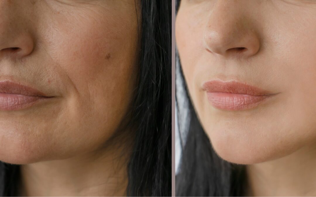 MESOPEELING ALL’OSSIGENO A TRE STRATI 
La nuova frontiera della cosmetologia av…