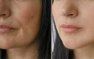 MESOPEELING ALL’OSSIGENO A TRE STRATI
La nuova frontiera della cosmetologia av…