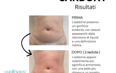Prima e dopo della CARBOXY (Carbossiterapia senza aghi ) sull’addome
Un percors…