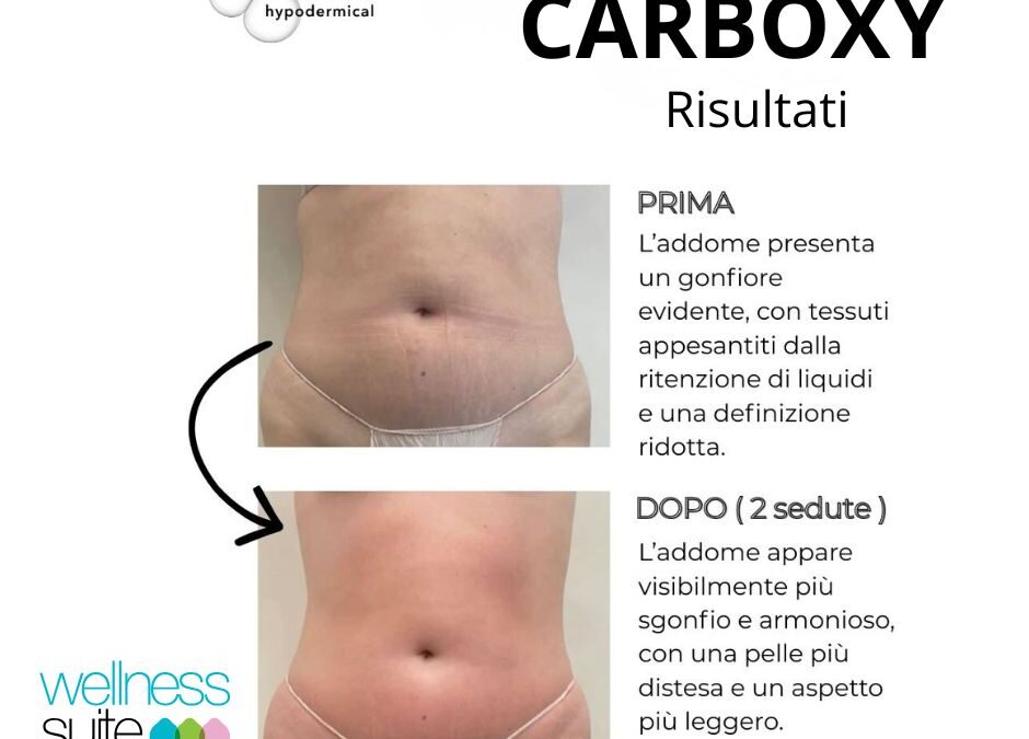 Prima e dopo della CARBOXY (Carbossiterapia senza aghi ) sull’addome 
Un percors…