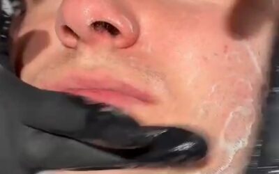 Brufoli, pelle lucida e segni dell’acne?

Scopri AGE REVERSE MESOPEELING protoc…