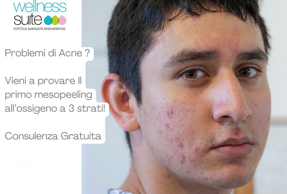 Le hai provate tutte, ma le acne sono sempre là… 
E se ti dicessimo che c’è un…