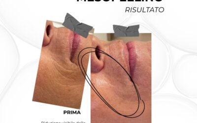 Le immagini parlano da sole.
Il nostro protocollo ANTIAGE Mesopeeling lavora in …