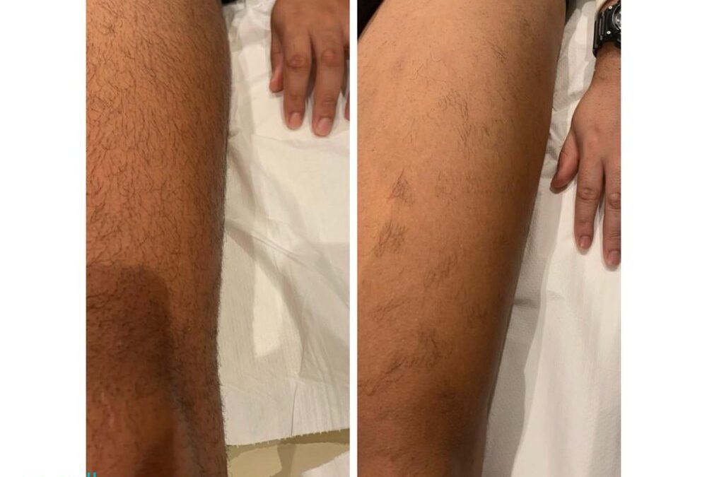 Sai qual è il segreto…? 
Dire addio ai peli superflui prima che arrivi l’estate….