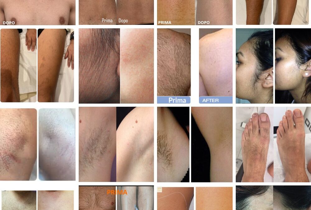Sono solo alcuni dei risultati reali ottenuti in oltre 10 anni di epilazione las…