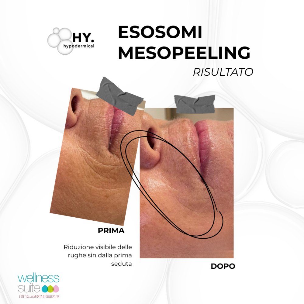 Trattamento Viso - AGE REVERSE ESOSOMI - immagine 2