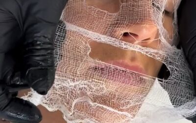 Problema Macchie? 
Mesopeeling Protocollo HY SPOTS (Oxygen Mesopeeling depigment…