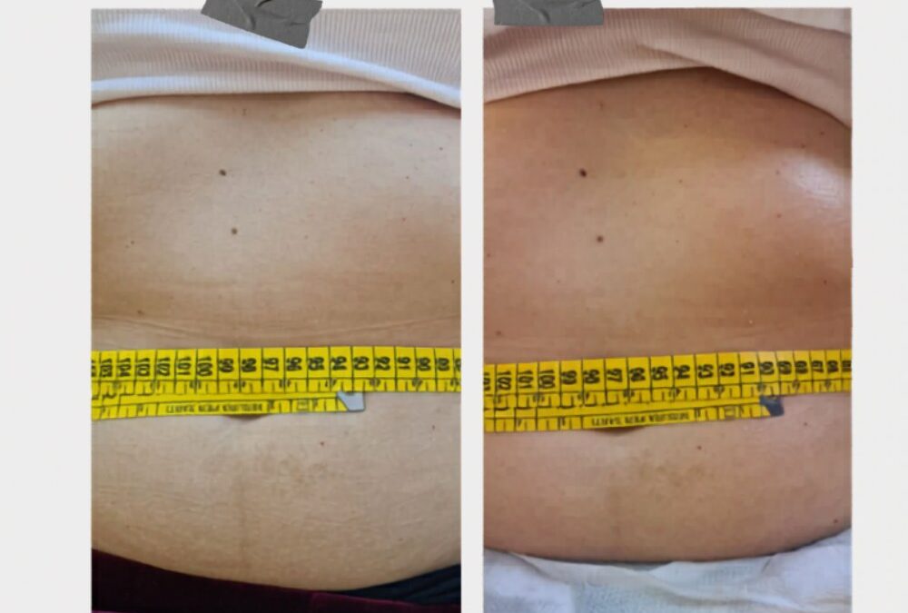 Tessuto disomogeneo o microcircolazione rallentata?
Con il nostro metodo profess…