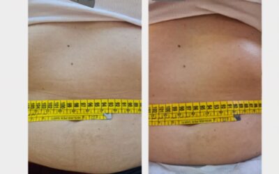 Tessuto disomogeneo o microcircolazione rallentata?
Con il nostro metodo profess…