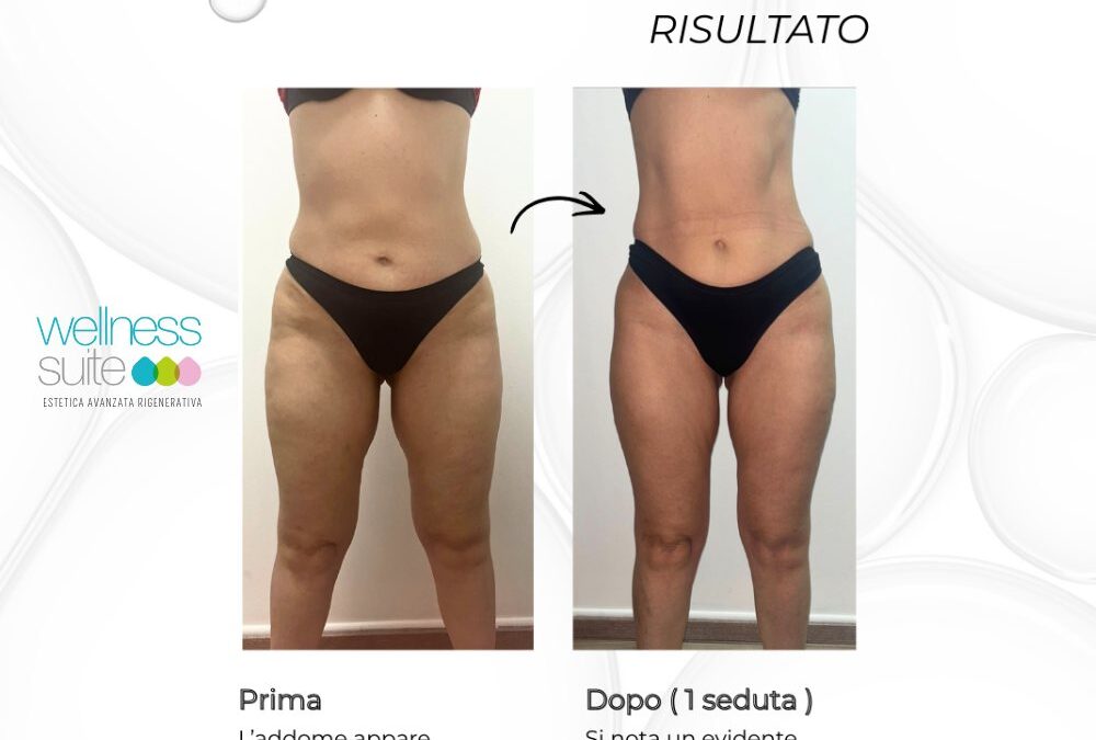 Vuoi vedere il tuo corpo cambiare già dalla prima seduta?
Prova CARBOXY senza ag…